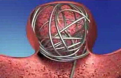 Neurovascular » COILS MICROPLEX