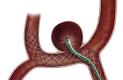 Neurovascular » Dispositivos Intraluminales