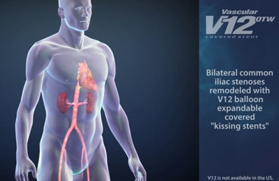 Advanta V12 Kissing Stents